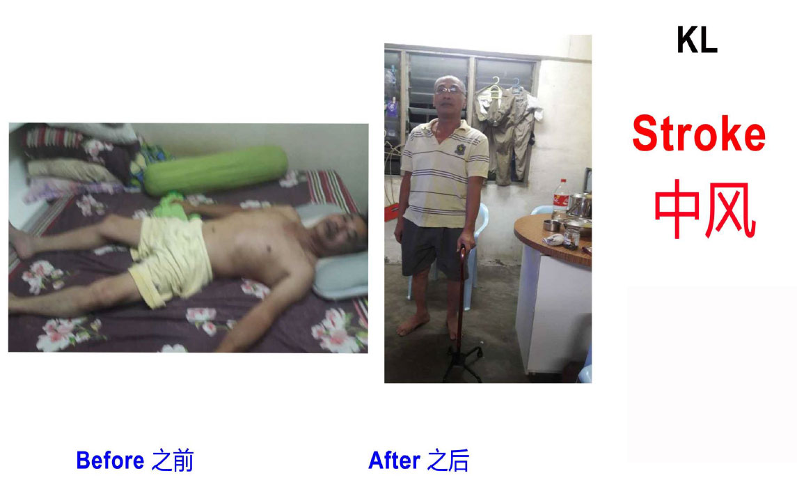 中风2