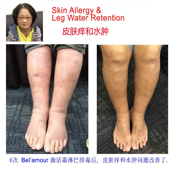 脚水肿2