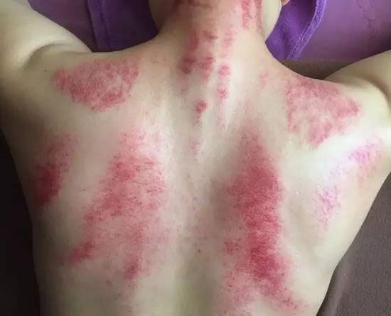 Gua Sha01