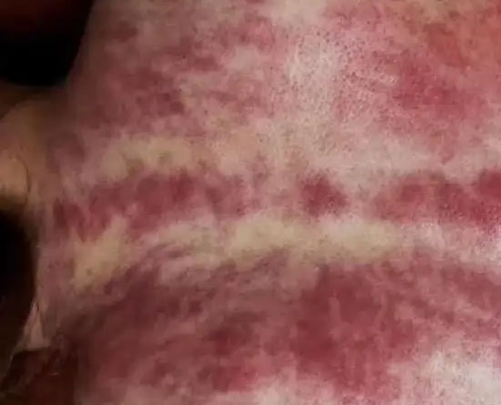 Gua Sha02