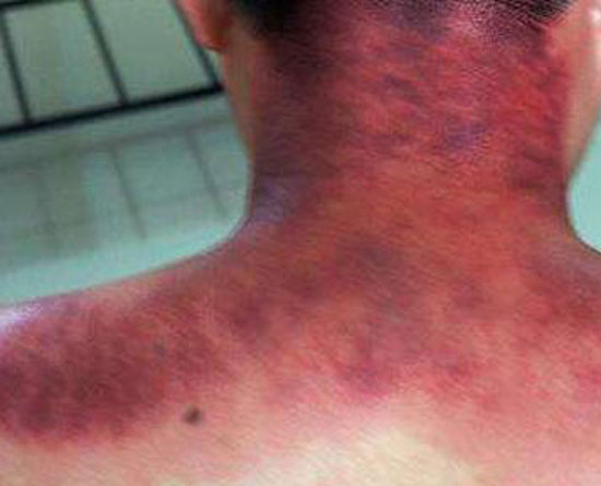 Gua Sha03